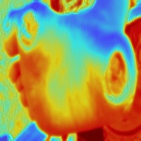 Foot Callus Detection project thumbnail