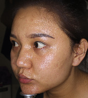 Acne project thumbnail