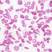 sickle cell detection real project thumbnail