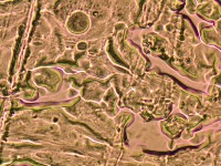 Kidney cancer project thumbnail