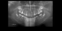 dental_opg_object_Detection project thumbnail