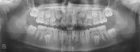 Dental OPG AI Detection project thumbnail