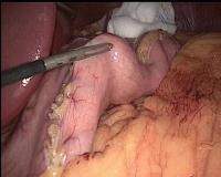 Sleeve Gastrectomy Labelling project thumbnail