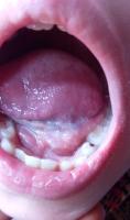Oral cancer project thumbnail