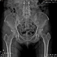 Hip xray project thumbnail