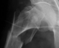 Hip fracture detection  project thumbnail