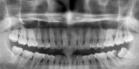 tooth segmentation project thumbnail