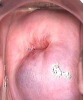 Box cervix type project thumbnail