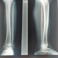 bone4 project thumbnail