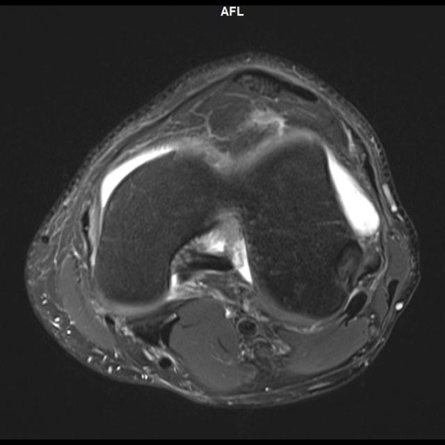 ACL and PCL Object Detection Dataset by Machine Learning