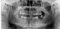 Judgment of missing teeth project thumbnail
