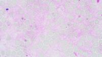 Malaria project thumbnail