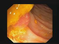 polyp project thumbnail