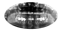 Tooth Detection Xray project thumbnail
