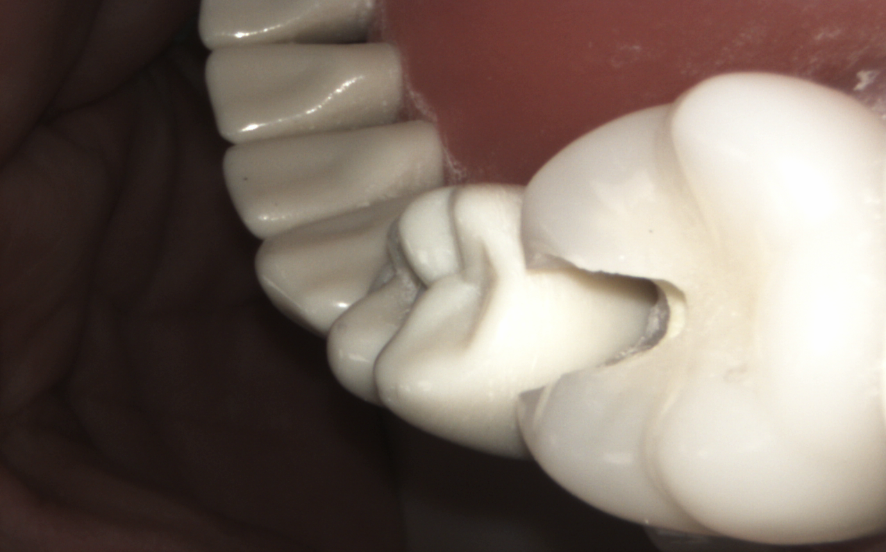 Tooth Structure Damage Adjacent Tooth Damage Object Detection Dataset by Qingrui
