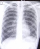 Pneumonia-detection-paper project thumbnail