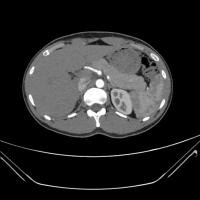 kidney disease project thumbnail