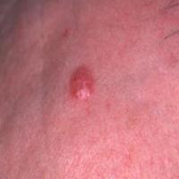 skin_diseases project thumbnail