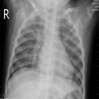 lung class project thumbnail
