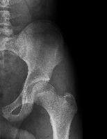 AI Hip project thumbnail