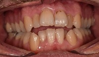 White Spot Lesions project thumbnail