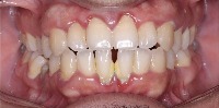 White Spot Lesions project thumbnail