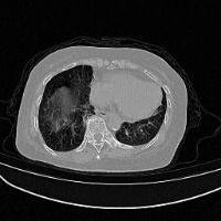 lung in CT project thumbnail