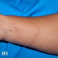 Urticaria project thumbnail