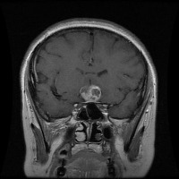BRAIN TUMOR project thumbnail