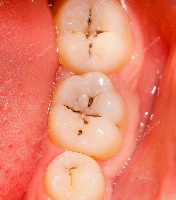 cavity project thumbnail