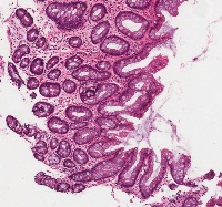 Intestinal metaplasia in BE project thumbnail