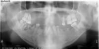 detector-terceiro-molar project thumbnail