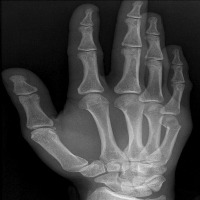Bone Fracture Classification project thumbnail