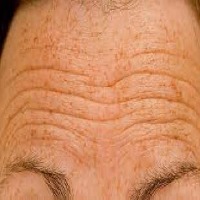 Hyperpigmentation and wrinkles Classification Dataset by upeksha