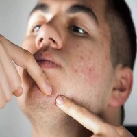 Hyperpigmentation and wrinkles Classification Dataset by upeksha