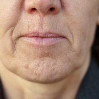 Hyperpigmentation and wrinkles Classification Dataset by upeksha