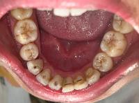 mandibular project thumbnail