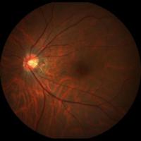 Fundus detection project thumbnail