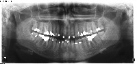 teeth project thumbnail