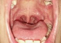 Oral Cancer Detection project thumbnail