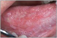 Oral Cancer Detection2 project thumbnail