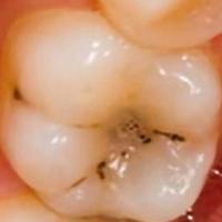ver10_04_caries_detection project thumbnail