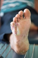 Foot Ulcer project thumbnail