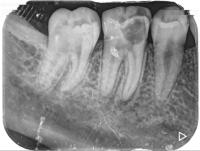 Detection of alveolar bone loss project thumbnail