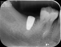 Detection of bone level project thumbnail