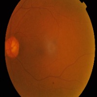 EYE & DIABETES project thumbnail