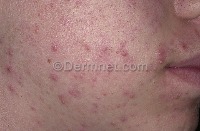 VS-skin-disease-classification project thumbnail
