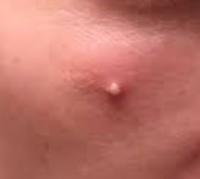 Acne project thumbnail