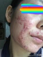 acne_detection project thumbnail