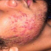 Acne project thumbnail